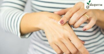 โดนน้ำมันลวก ปฐมพยาบาล, โดนน้ำมันลวก ทายาอะไร