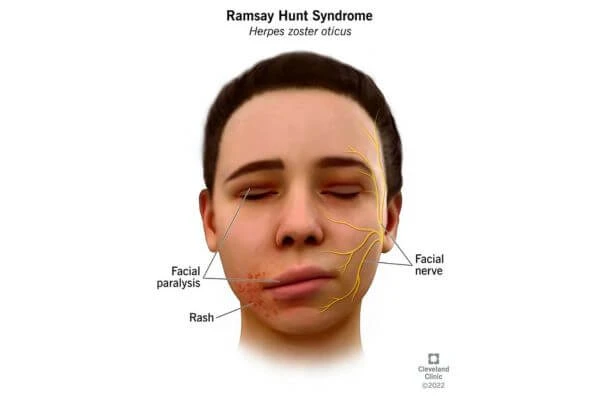 Ramsay Hunt Syndrome คือ, อัมพาตครึ่งหน้า