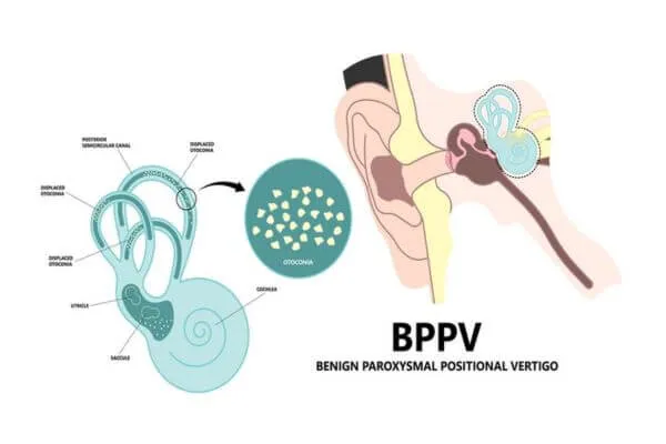 หินปูนในหูเคลื่อนหายเองได้ไหม, หินปูนในหูหลุดเกิดจากอะไร